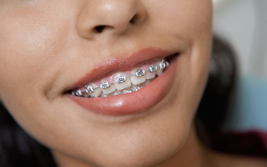 Dental Plans for Orthodontia Coverage